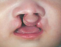 口唇口蓋裂治療